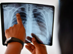 Tuberculosis: un 80% más de casos en Argentina, con la mayor incidencia en Salta Foto: AFP